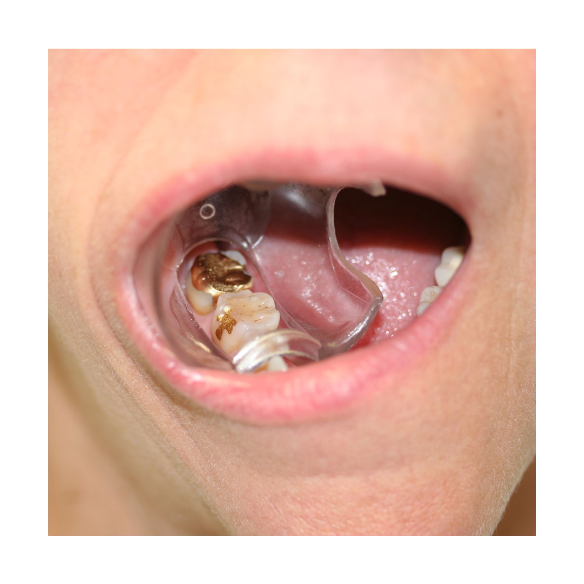 Dry Field Mouth Props