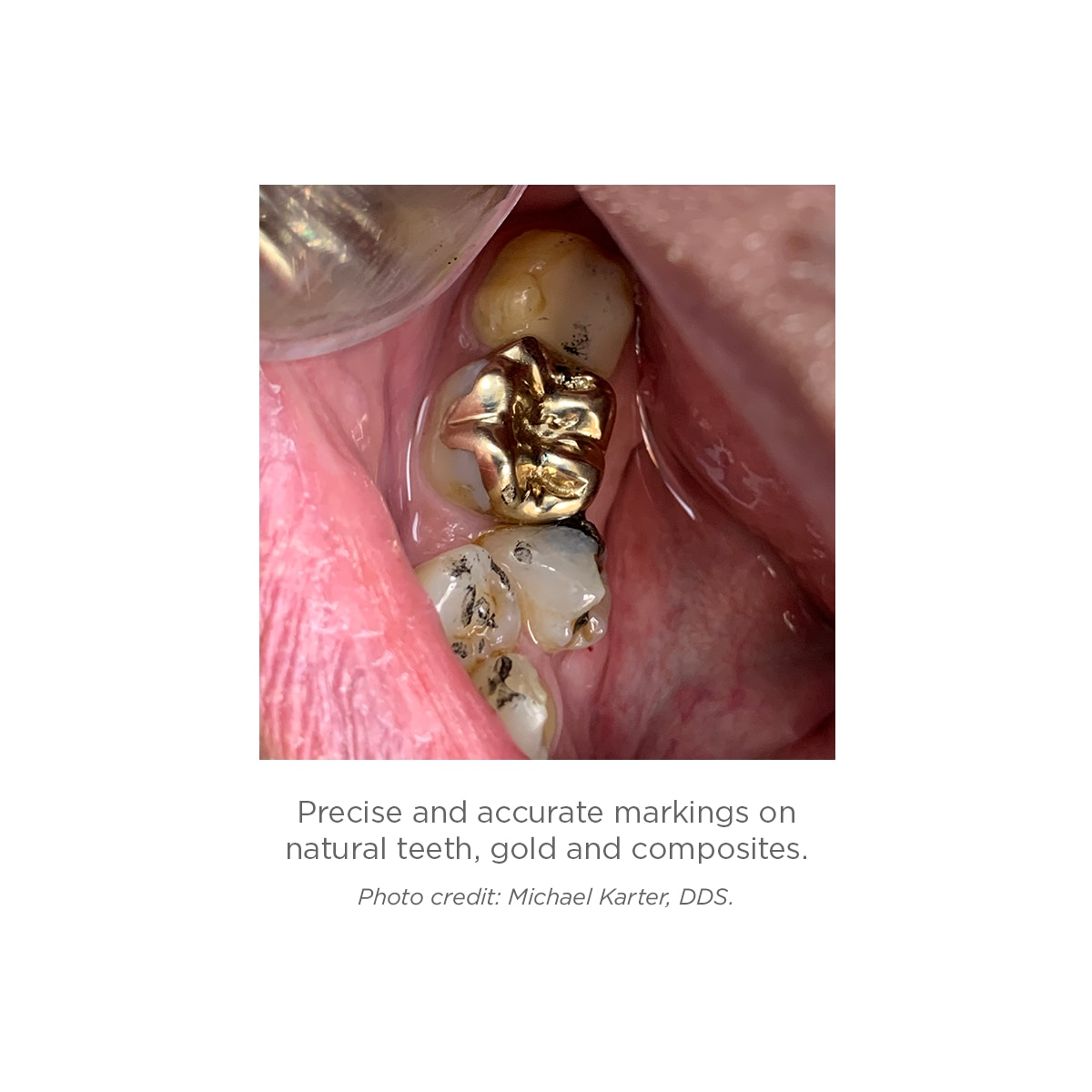 Clinical image of AccuFilm on teeth