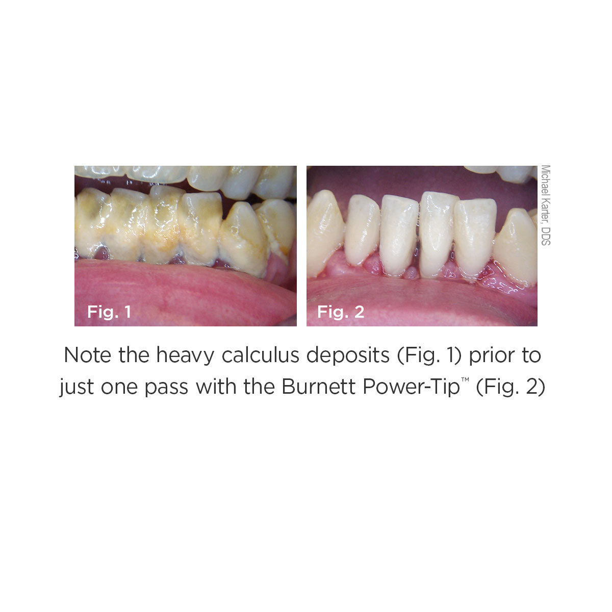 Burnett Power Tip Clinical Images