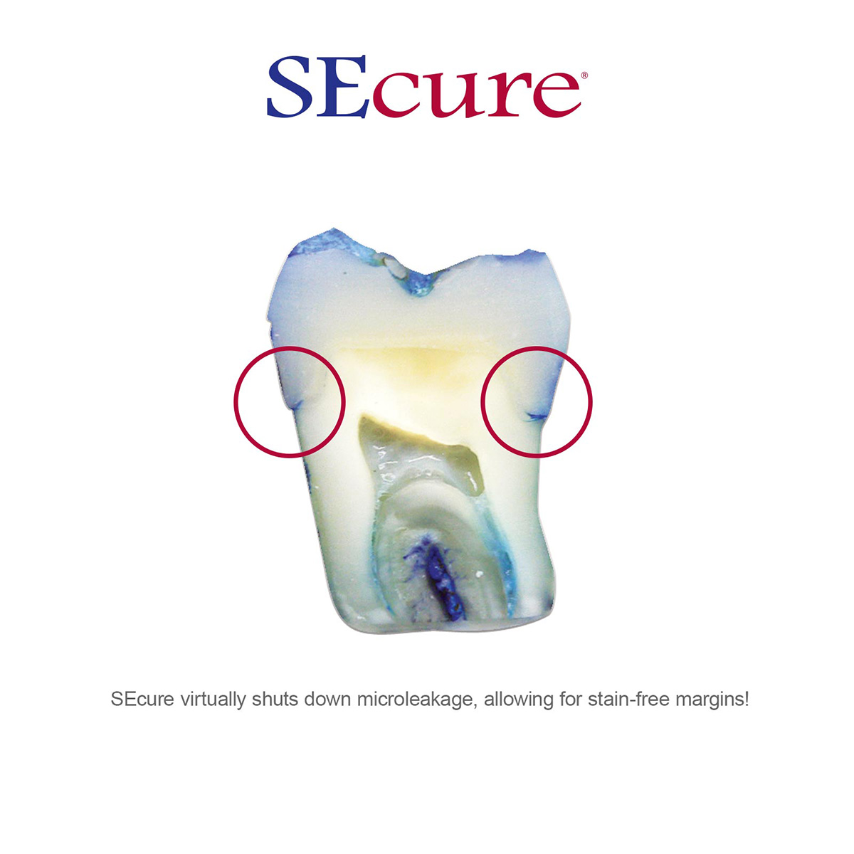 SEcure® Resin Cement clinical